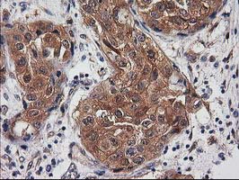 IHC of paraffin-embedded Carcinoma of Human bladder tissue using anti-DSTN mouse monoclonal antibody.