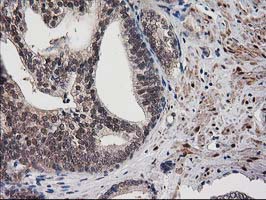 IHC of paraffin-embedded Carcinoma of Human prostate tissue using anti-DSTN mouse monoclonal antibody.