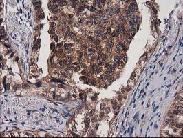 IHC of paraffin-embedded Carcinoma of Human lung tissue using anti-DSTN mouse monoclonal antibody.