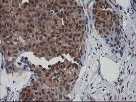 IHC of paraffin-embedded Adenocarcinoma of Human breast tissue using anti-DSTN mouse monoclonal antibody.