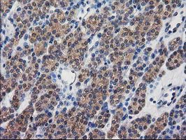 IHC of paraffin-embedded Carcinoma of Human thyroid tissue using anti-DSTN mouse monoclonal antibody.