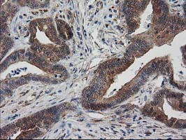 IHC of paraffin-embedded Adenocarcinoma of Human colon tissue using anti-DSTN mouse monoclonal antibody.