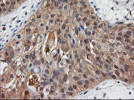 IHC of paraffin-embedded Carcinoma of Human bladder tissue using anti-DSTN mouse monoclonal antibody.