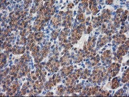 IHC of paraffin-embedded Carcinoma of Human thyroid tissue using anti-DSTN mouse monoclonal antibody.