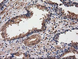 IHC of paraffin-embedded Carcinoma of Human prostate tissue using anti-DSTN mouse monoclonal antibody.