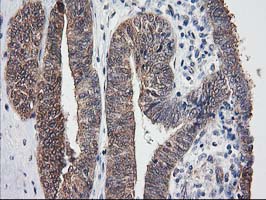 IHC of paraffin-embedded Adenocarcinoma of Human endometrium tissue using anti-DSTN mouse monoclonal antibody.