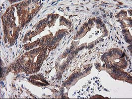 IHC of paraffin-embedded Adenocarcinoma of Human colon tissue using anti-DSTN mouse monoclonal antibody.