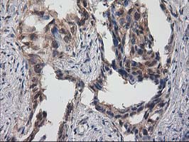 IHC of paraffin-embedded Carcinoma of Human lung tissue using anti-DSTN mouse monoclonal antibody.