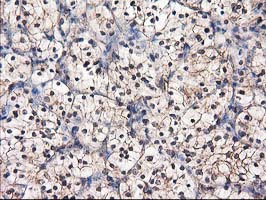 IHC of paraffin-embedded Carcinoma of Human kidney tissue using anti-DSTN mouse monoclonal antibody.