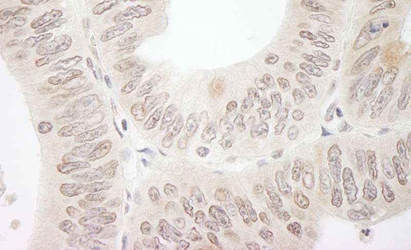 Detection of Human DTL/CDT2 by Immunohistochemistry. Sample: FFPE section of human colon carcinoma. Antibody: Affinity purified rabbit anti-DTL/CDT2 used at a dilution of 1:1000 (1 Detection: DAB.