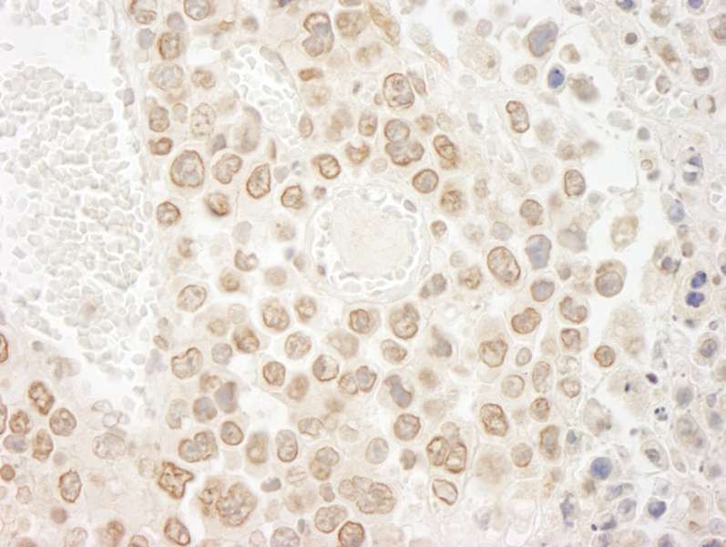 Detection of Mouse DTL/CDT2 by Immunohistochemistry. Sample: FFPE section of mouse hybridoma tumor. Antibody: Affinity purified rabbit anti-DTL/CDT2 used at a dilution of 1:250. Epitope Retrieval Buffer-High pH (IHC-101J) was substituted for Epitope Retrieval Buffer-Reduced pH.