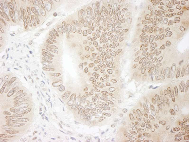 Detection of Human DTL/CDT2 by Immunohistochemistry. Sample: FFPE section of human colon carcinoma. Antibody: Affinity purified rabbit anti-DTL/CDT2 used at a dilution of 1:250. Epitope Retrieval Buffer-High pH (IHC-101J) was substituted for Epitope Retrieval Buffer-Reduced pH.