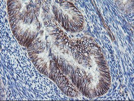 IHC of paraffin-embedded Adenocarcinoma of Human endometrium tissue using anti-DTNB mouse monoclonal antibody.