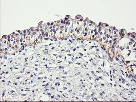IHC of paraffin-embedded Carcinoma of Human bladder tissue using anti-DTNB mouse monoclonal antibody.