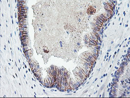IHC of paraffin-embedded Carcinoma of Human prostate tissue using anti-DTNB mouse monoclonal antibody.