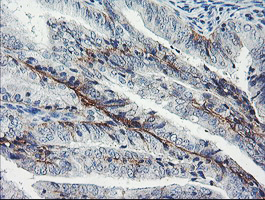 IHC of paraffin-embedded Adenocarcinoma of Human endometrium tissue using anti-DTNB mouse monoclonal antibody.