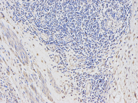 Immunohistochemistry of paraffin-embedded human esophageal cancer using DTNBP1 antibody at dilution of 1:100 (200x lens).
