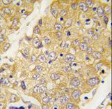 Formalin-fixed and paraffin-embedded human hepatocarcinoma tissue reacted with Dtnbp1 Antibody , which was peroxidase-conjugated to the secondary antibody, followed by DAB staining. This data demonstrates the use of this antibody for immunohistochemistry; clinical relevance has not been evaluated.