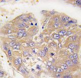 Formalin-fixed and paraffin-embedded human hepatocarcinoma tissue reacted with Dtnbp1 Antibody , which was peroxidase-conjugated to the secondary antibody, followed by DAB staining. This data demonstrates the use of this antibody for immunohistochemistry; clinical relevance has not been evaluated.