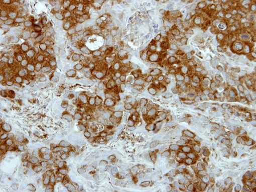 IHC of paraffin-embedded BT474 xenograft using Deltex1 antibody at 1:500 dilution.