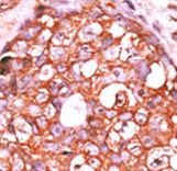 Formalin-fixed and paraffin-embedded human cancer tissue reacted with the primary antibody, which was peroxidase-conjugated to the secondary antibody, followed by AEC staining. This data demonstrates the use of this antibody for immunohistochemistry; clinical relevance has not been evaluated. BC = breast carcinoma; HC = hepatocarcinoma.