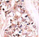 Formalin-fixed and paraffin-embedded human cancer tissue reacted with the primary antibody, which was peroxidase-conjugated to the secondary antibody, followed by AEC staining. This data demonstrates the use of this antibody for immunohistochemistry; clinical relevance has not been evaluated. BC = breast carcinoma; HC = hepatocarcinoma.