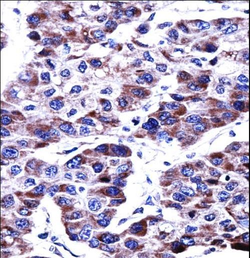 DUSP9 Antibody immunohistochemistry of formalin-fixed and paraffin-embedded human hepatocarcinoma followed by peroxidase-conjugated secondary antibody and DAB staining.