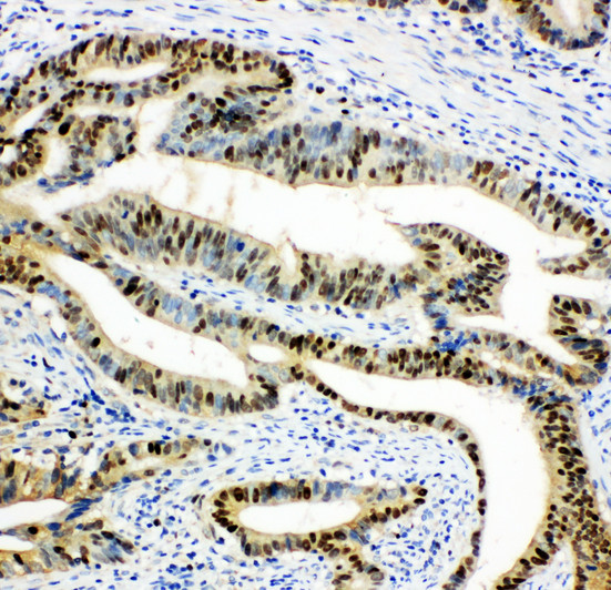DUT / DUTPase antibody. IHC(P): Human Intestinal Cancer Tissue.