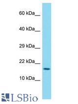 DUX1 antibody Western Blot of Esophagus Tumor. Antibody dilution: 1 ug/ml.