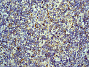 IHC of paraffin-embedded human Hodgkins lymphoma tissue using anti-CLIP1 / CLIP170 antibody.