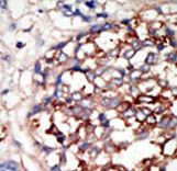 Formalin-fixed and paraffin-embedded human cancer tissue reacted with the primary antibody, which was peroxidase-conjugated to the secondary antibody, followed by DAB staining. This data demonstrates the use of this antibody for immunohistochemistry; clinical relevance has not been evaluated. BC = breast carcinoma; HC = hepatocarcinoma.