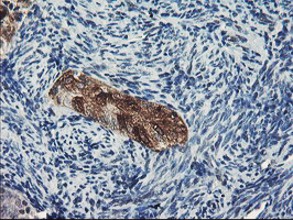 IHC of paraffin-embedded Adenocarcinoma of Human endometrium tissue using anti-DPP8 mouse monoclonal antibody.
