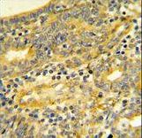 DPP8 Antibody IHC of formalin-fixed and paraffin-embedded human Prostate carcinoma followed by peroxidase-conjugated secondary antibody and DAB staining.