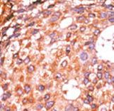 Formalin-fixed and paraffin-embedded human cancer tissue reacted with the primary antibody, which was peroxidase-conjugated to the secondary antibody, followed by AEC staining. This data demonstrates the use of this antibody for immunohistochemistry; clinical relevance has not been evaluated. BC = breast carcinoma; HC = hepatocarcinoma.