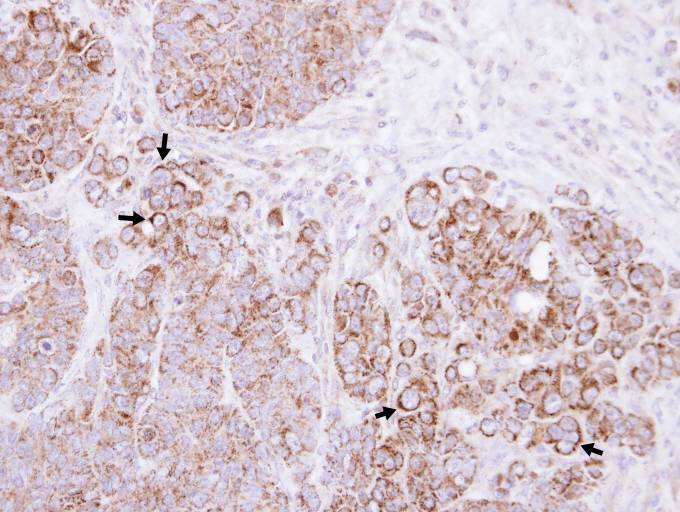 IHC of paraffin-embedded SW480 xenograft using Alpha-catulin antibody at 1:100 dilution.