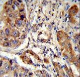 Formalin-fixed and paraffin-embedded human hepatocarcinoma reacted with EBP Antibody , which was peroxidase-conjugated to the secondary antibody, followed by DAB staining. This data demonstrates the use of this antibody for immunohistochemistry; clinical relevance has not been evaluated.