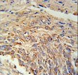 EBPL Antibody immunohistochemistry of formalin-fixed and paraffin-embedded human lung carcinoma followed by peroxidase-conjugated secondary antibody and DAB staining.