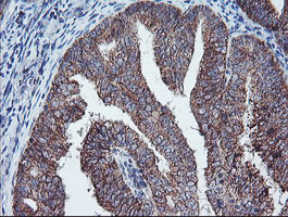 IHC of paraffin-embedded Adenocarcinoma of Human endometrium tissue using anti-PECI mouse monoclonal antibody. (Heat-induced epitope retrieval by 10mM citric buffer, pH6.0, 100C for 10min).