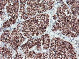 IHC of paraffin-embedded Carcinoma of Human liver tissue using anti-PECI mouse monoclonal antibody. (Heat-induced epitope retrieval by 10mM citric buffer, pH6.0, 100C for 10min).
