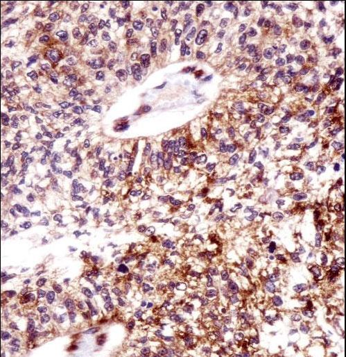 ECT2 Antibody immunohistochemistry of formalin-fixed and paraffin-embedded human lung squamous carcinoma followed by peroxidase-conjugated secondary antibody and DAB staining.