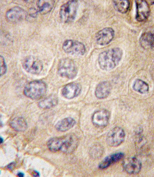Formalin-fixed and paraffin-embedded human hepatocarcinoma tissue reacted with EDA antibody , which was peroxidase-conjugated to the secondary antibody, followed by DAB staining. This data demonstrates the use of this antibody for immunohistochemistry; clinical relevance has not been evaluated.