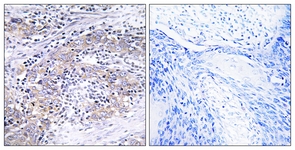 IHC of paraffin-embedded human cervix carcinoma tissue, using CLN6 Antibody. The picture on the right is treated with the synthesized peptide.