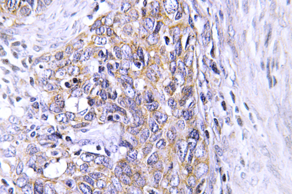 IHC of CLN6 (N258) pAb in paraffin-embedded human cervix carcinoma tissue.