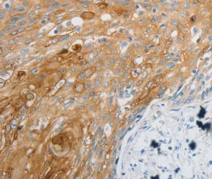 Immunohistochemistry of paraffin-embedded human cervical cancer tissue t using EDNRB antibody.