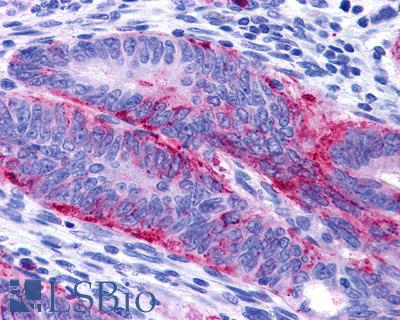 Anti-EDNRB / Endothelin B Receptor antibody IHC of human Colon, Carcinoma. Immunohistochemistry of formalin-fixed, paraffin-embedded tissue after heat-induced antigen retrieval.