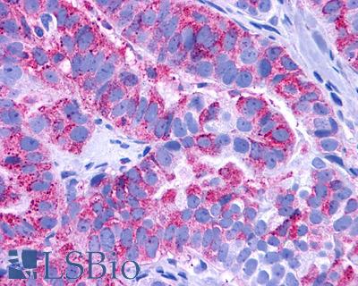 Anti-EDNRB / Endothelin B Receptor antibody IHC of human Ovary, Carcinoma. Immunohistochemistry of formalin-fixed, paraffin-embedded tissue after heat-induced antigen retrieval.