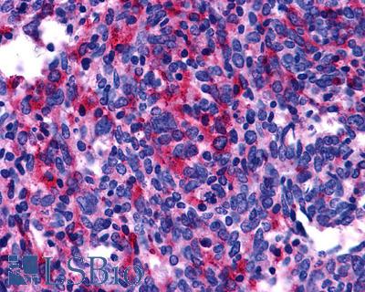 Anti-EDNRB / Endothelin B Receptor antibody IHC of human Lung, Small Cell Carcinoma. Immunohistochemistry of formalin-fixed, paraffin-embedded tissue after heat-induced antigen retrieval.
