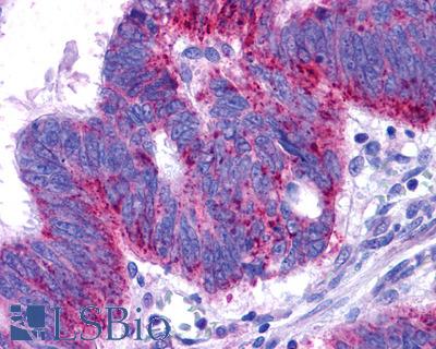 Anti-EDNRB / Endothelin B Receptor antibody IHC of human Colon, Carcinoma. Immunohistochemistry of formalin-fixed, paraffin-embedded tissue after heat-induced antigen retrieval.