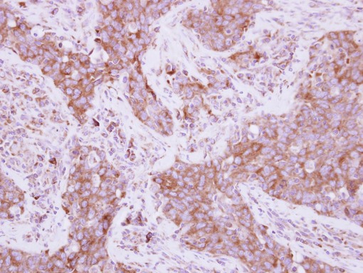 IHC of paraffin-embedded AdCA, using EEF1D antibody at 1:250 dilution.