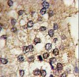 Formalin-fixed and paraffin-embedded human prostate carcinoma tissue reacted with CLOCK antibody , which was peroxidase-conjugated to the secondary antibody, followed by DAB staining. This data demonstrates the use of this antibody for immunohistochemistry; clinical relevance has not been evaluated.